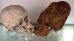 UN NORMALE CRANIO UMANO A CONFRONTO CON UNO DI PARACAS