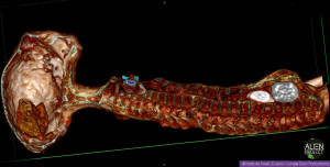 LA TOMOGRAFIA CHE MOSTRA L'UOVO ALL'INTERNO DI UNA MUMMIA